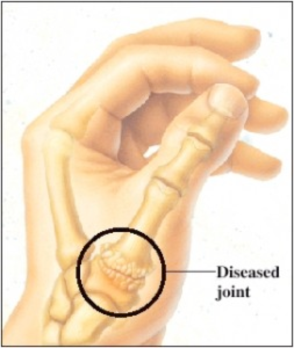 Ask The Yoga Therapist Thumbs Up For Thumb Arthritis Soul Of Yoga   Diseased Joint 